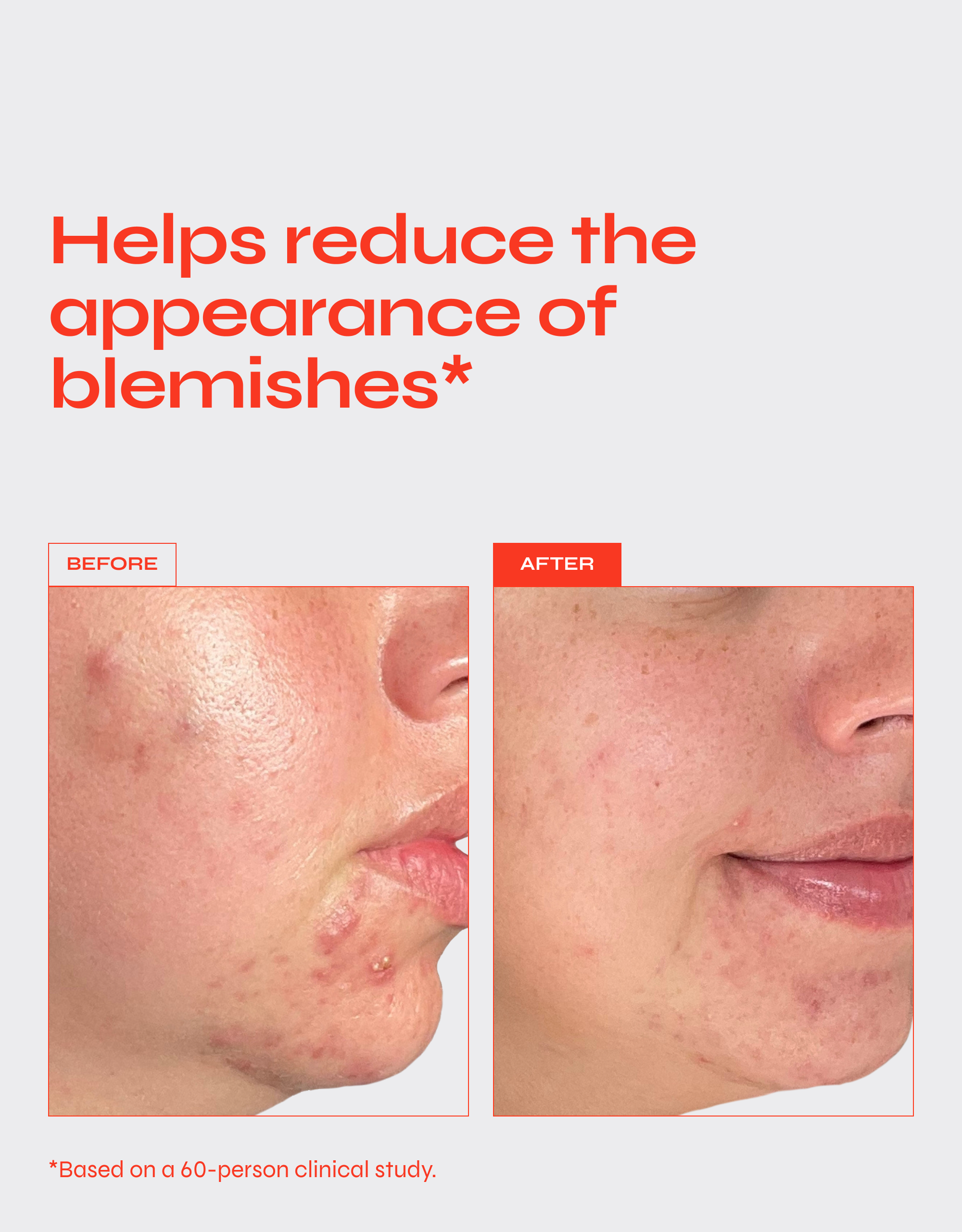 Facile Acne-Clearing Treatment